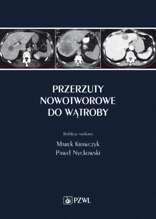 Przerzuty nowotworowe do wątroby, Marek Krawczyk